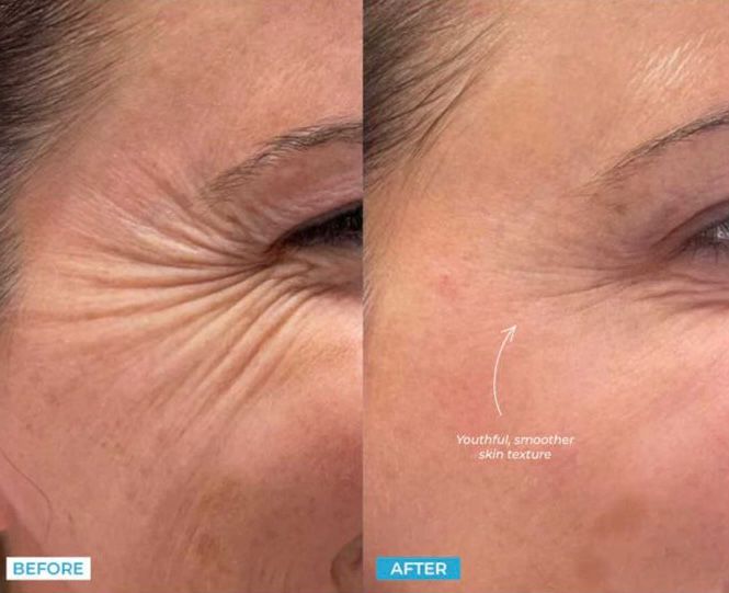 Intense Pulsed Light